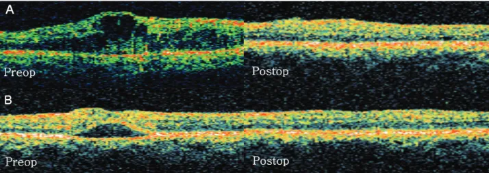 Figure 5. DME pattern changes before and after IVTA injection at 1 month. The OCT feature changed to diffuse thickened  macula (Type 1) in (A) 74% of cystoid macular edema (Type 2), (B) 83% of serous retinal detachment (Type 3); DME=diabetic macular edema;