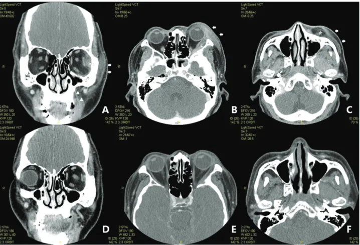 Figure 1. Odontogenic orbital cellulitis in a 55-year-old man with the route of spread via the soft tissue of the cheek