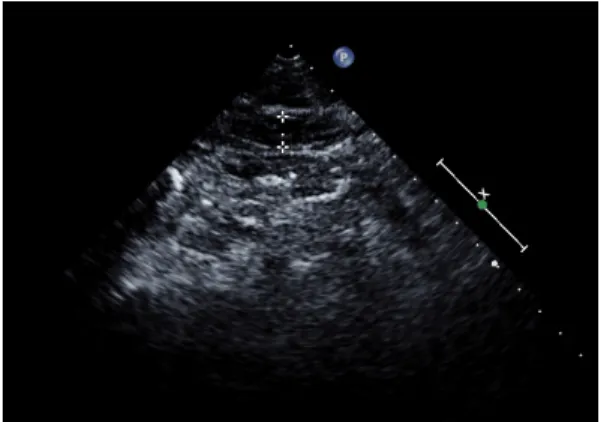 Fig. 4. subcutaneous fat (sub-fat) 검진대상자는  교육된  측정자에  의해  신장과  체중,  혈 압은  0.1  kg,  0.1  cm까지  측정된  자료를  연구  분석에  이 용하였고,  체질량지수(BMI)는  체중을  신장의  제곱으로  나누어(kg/㎡)구하였다