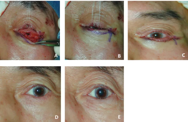 Figure 4. Orbicularis muscle and skin flap excision. (A) After lower lid retractor reinsertion