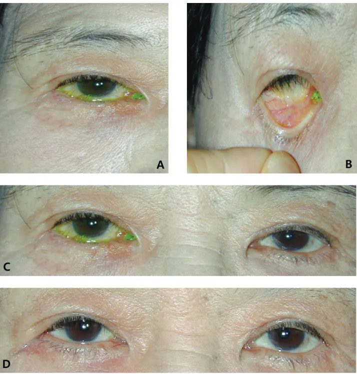 Figure 5. (A)(B) The patient shows involutional entropion with horizontal lid laxity. (C) Preoperative picture