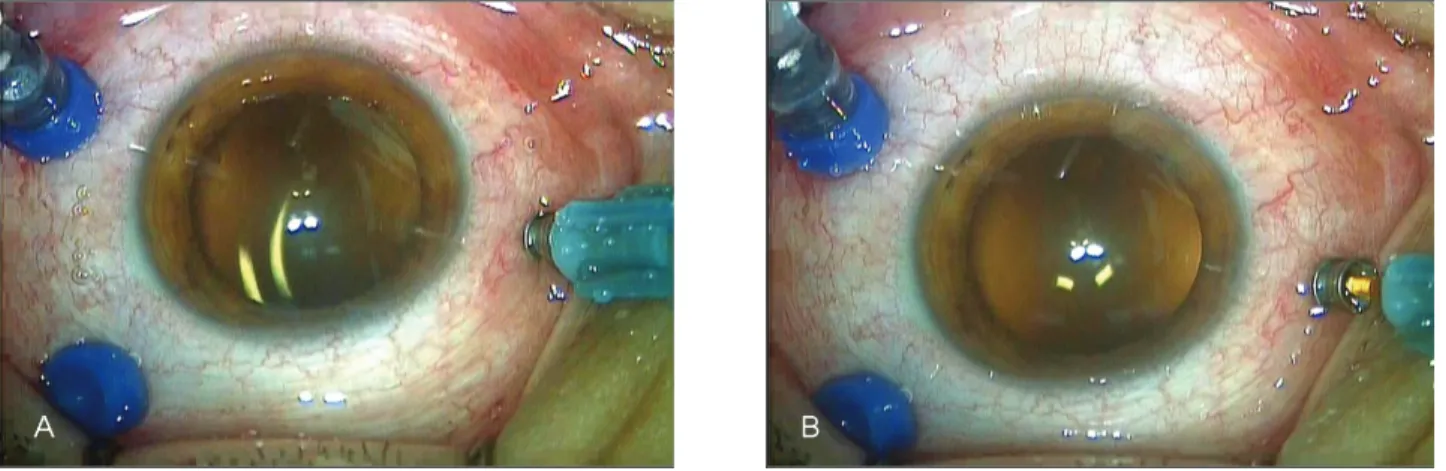 Table 1. Characteristics of patients of silicone oil removal using 23-gauge transconjunctival sutureless vitrectomy system and  20-gauge vitrectomy system