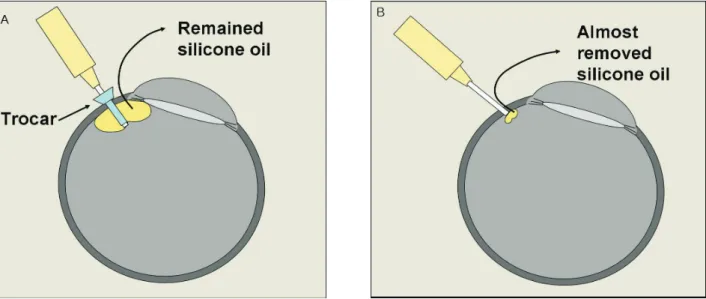Table 3. The mean preoperative, postoperative 1-day, 1-week, 1-month intraocular pressure after silicone oil removal using  23-gauge transconjunctival sutureless vitrectomy system and 20-gauge vitrectomy system