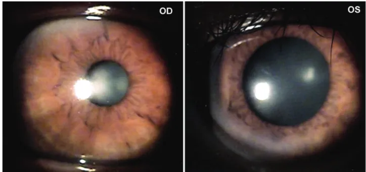 Figure 1. Slit-lamp photograph at one hour after 0.125% pilocarpine instillation in a 53-year-old man with a fifteen-day history  of pupil dilation in the left eye at the first visit.