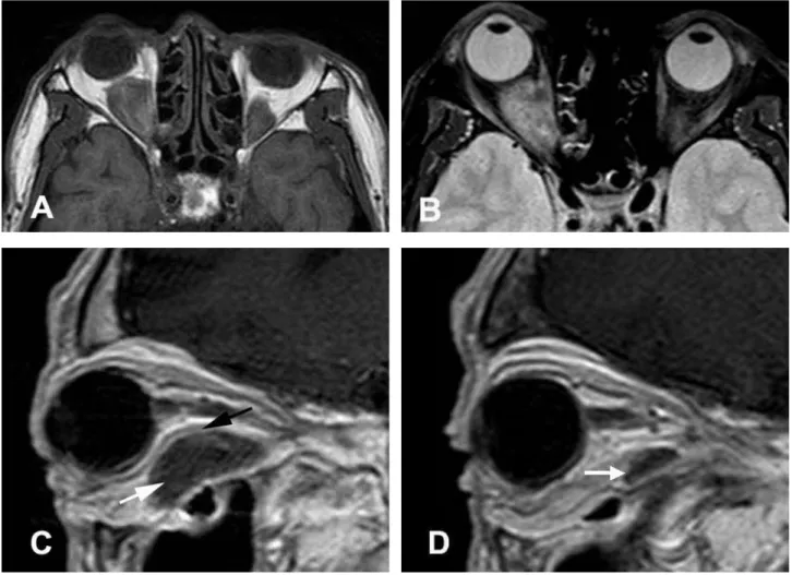 Figure 1. Pre-operative CT and MRI findings (2 weeks before excisional biopsy). Post-enhancement axial (A) and coronal (B)  CT scan show the right eyeball is protruded compared with the left eyeball and homogenous, subtle enhanced, well demarcated  round o