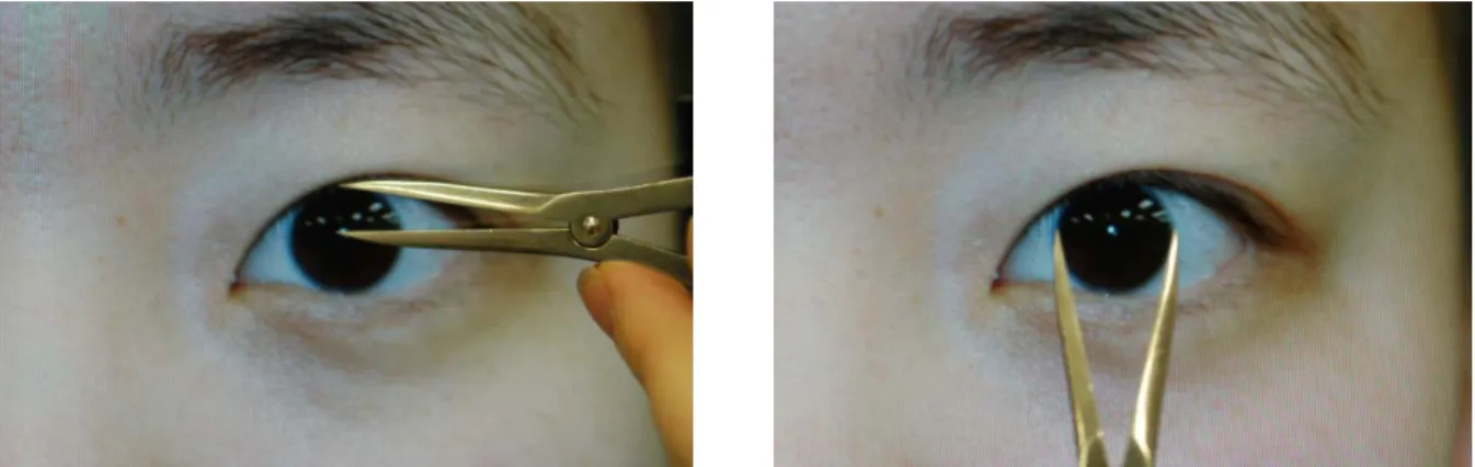 Figure 2. Lid height at surgery is evaluated with the patient seated.