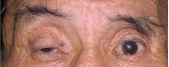 Figure 2. Right upper lid ptosis following botulinum A  toxin injection