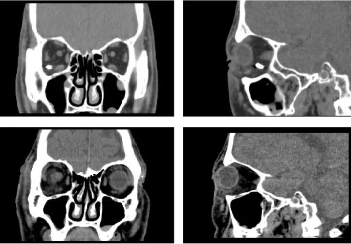 Figure 2. Preoperative (upper) and postoperative (lower) coronal and sagittal views of orbital CT scans