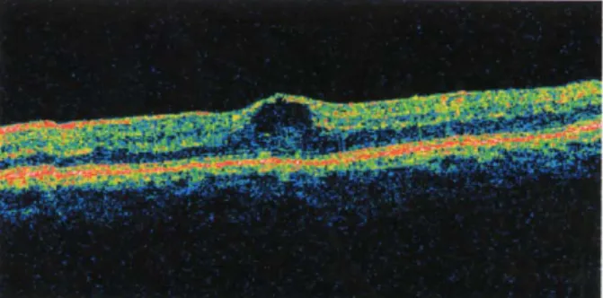 Figure 2. Optical coherence tomography (OCT) of the  patient's left eye, two weeks after discontinuation of  rosiglitazone showed marked decrease of subretinal fluid at  the central macula.