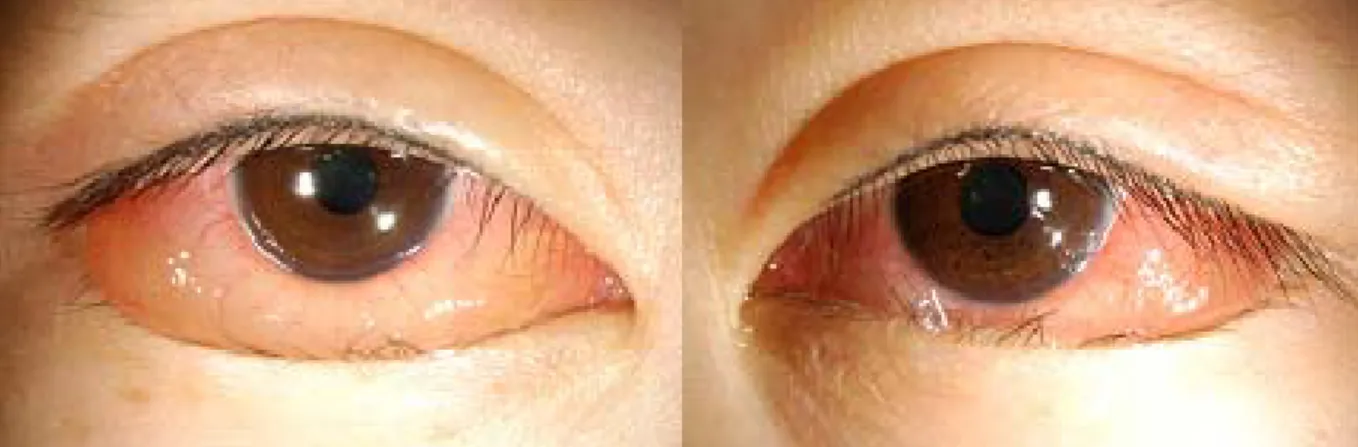 Figure 2. The  bulbar conjunctivas were markedly chemotic on the 3rd hospital day, but after systemic steroid therapy the  chemosis subsided and the conjunctivas  became normal on the 12th hospital day.
