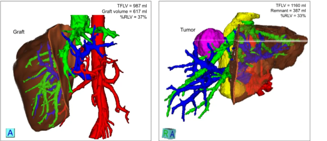 Figure 7. Examples of liver surgery planning results (left: LDLT; right: tumor resection) by a sphere-based liver surgery planning module in Dr