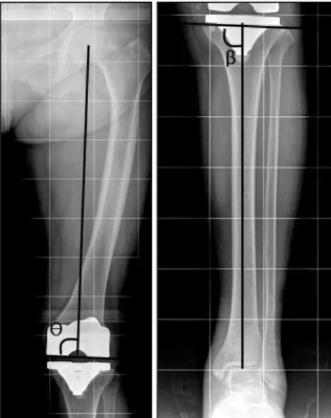 Fig.  1.  A  mechanical  axis  (MA)  was  formed  between  the  mecha- mecha-nical  axis  of  the  femur  and  the  tibia.