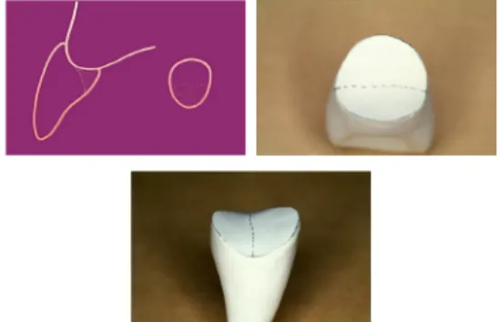 Fig 3. Set up by putty in main model (labial,  lingual view)