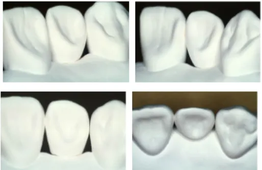 Fig 14. Ridge lap pontic base is    made as the  new technology.