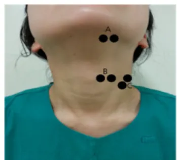 Figure 2. Electrode position(A, Suprahyoid muscle; 