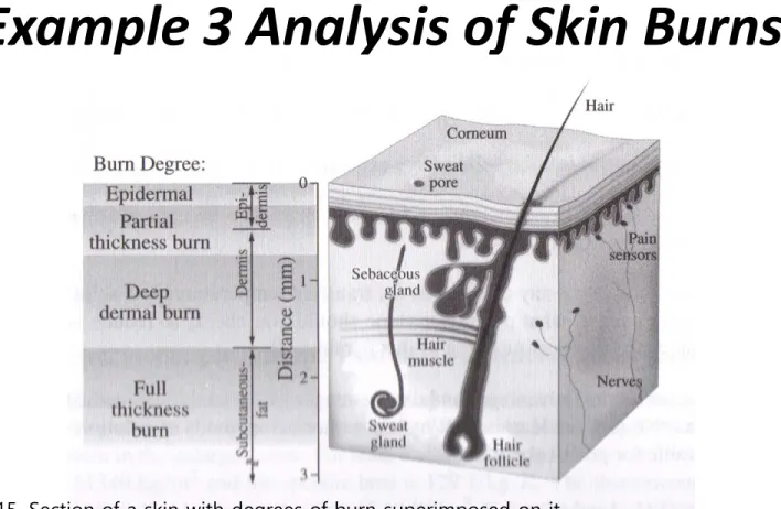 Figure 15. Section of a skin with degrees of burn superimposed on it. 