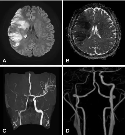 Fig. 1. Initial brain magnetic resonance images and MR angiography. Diffusion weighted image (DWI) and apparent diffusion coefficient (ADC) image revealed right middle cerebral artery territory infarction (A,  B)