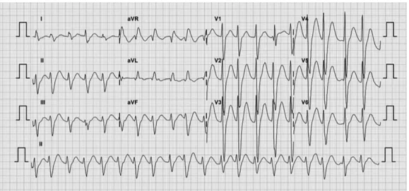 Fig. 2. After 2 hours, QRS widening and ST segment change were not seen on the ECG.