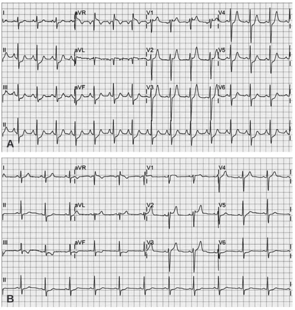 Fig. 1. (A) Initial electrocardiogram shows ST segment depression in leads I, II, III, aVF and V4-6