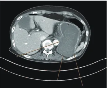 Fig. 3. Abdomen computed tomography scans showed a peri- peri-gastric fluid collection in accordance with a perforation of the stomach (between lines).