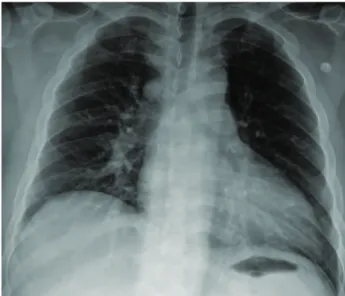 Fig. 1. Postero-anterior chest X-ray. Postero-anterior chest x-ray shows no abnormalities except mild pulmonary edema  (vas-cular cephalization).