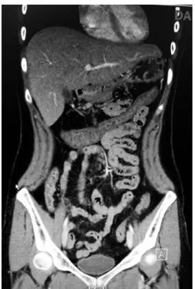 Fig. 1. Abdominal Computed tomography (CT): The abdominal CT shows the edematous changes in the entire colon and terminal ileum, the prominent para-aortic nodes.