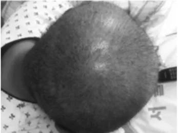 Fig. 2. Desquamation on hand. Fig. 3. Desquamation on feet. 