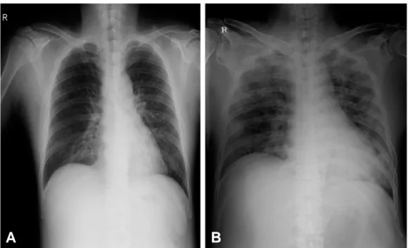 Fig. 3. (A) Chest PA (4th hospital day): There are pneum onic infiltrations in both lung fields