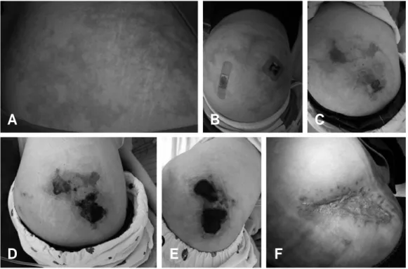 Fig. 2. Ultrasonographic study at both buttocks. (A) Left buttock. (B) Right buttock (injection area)