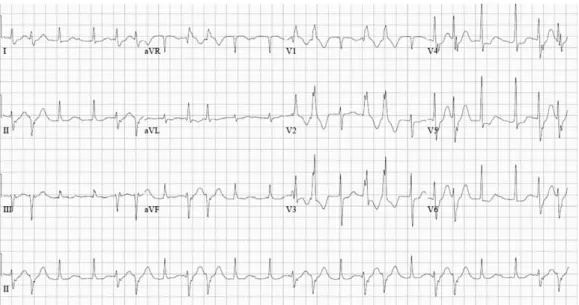 Fig. 2. Accelerated junctional rhythm with ventricular premature beats - It was documented 1.5 hours after repeated anti-arrhythmic drug infusion.