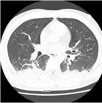 Fig. 5. Brain CT of patient B. It shows normal gray-white matter.