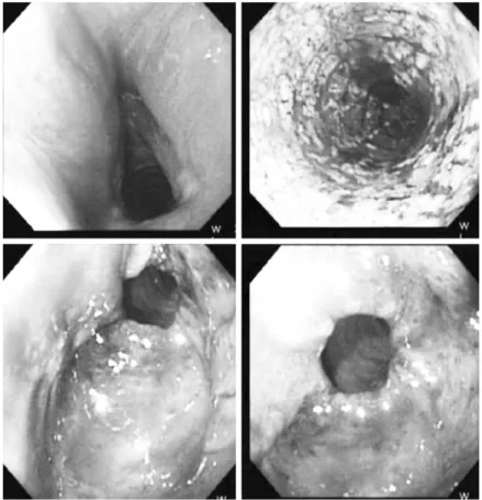 Fig. 1. The endoscopic findings of patient at the initial presentation. Entire esophagus is covered with whitish plaque and showed edema and spontaneous bleeding