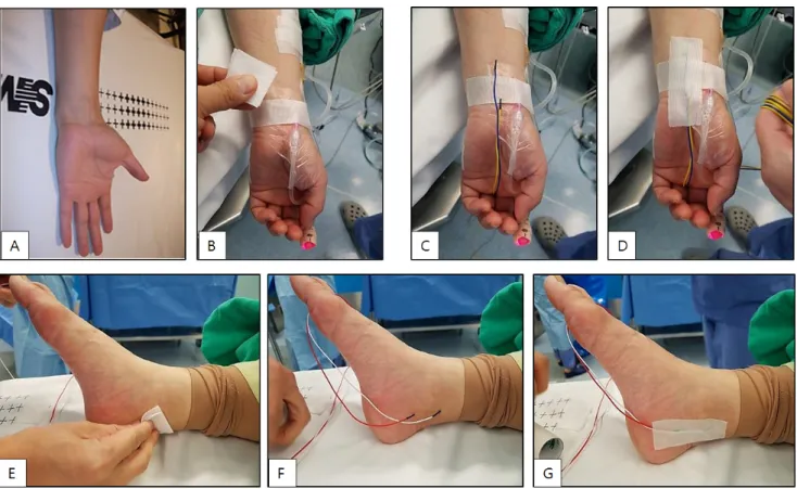 Figure 4. Insert stimulator electrode for median nerve somatosensory evoked potential, (A) patient’s hand, (B) disinfection with alcohol cotton,  (C) insert electrode SSEP stimulator, (D) tapping for fixing