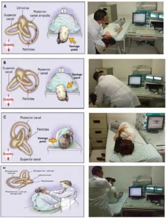 Figure  1.  Epley  maneuver  (right  ear).  The  patient  is  seated  on  a  table  as  viewed  from  the  right  side