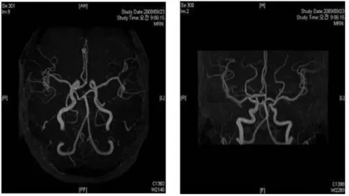 Figure  5.  BA  abnormality  in  MRA. 