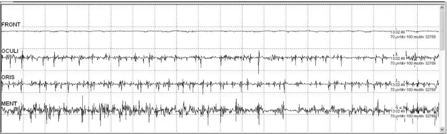 Fig.  6.  Electromyography  of  self  activity. 첫째, 환자의 호흡곡선에 자발호흡의 조짐이 관찰된다. 둘째, 혈 압이 서서히 오른다