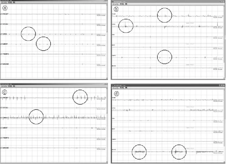 Fig.  9.  Observed  waveform  is  difficult  shown  case. 행이 되었던 경우를 살펴보면 수술 후 환자의 안면신경상태도 대부분 좋았다.둘째, 수술 전과는 다르게 수술 후에 안면신경의 손상이 심각하였던 경우를 살펴보면, 앞에서 거론한 결과1의 다섯 번째에 해당하는 안면신경이 종양으로 인하여 납작하게 펼쳐져서 육안으로 구분이 안 되는 경우가 대부분 해당이 되었다