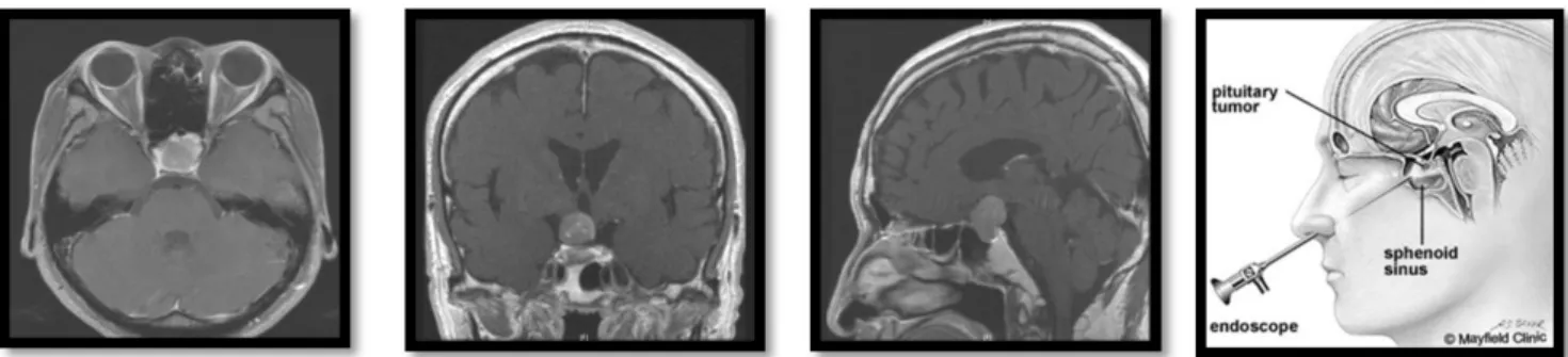 Fig.  1.  MRI  of  pituitary  adenoma  and  illustration  of  trans  spenoide  approach  endoscope.
