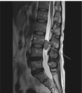 Fig.  8.  PA  of  scoliosis.