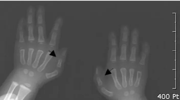 Fig. 1. Both hand X-ray. Showing of both thumbs syndactyly  (arrow).