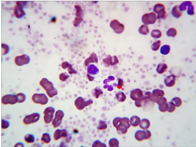 Fig. 1. Perpheral blood smear showing intracytoplasmic morula in  the neutrophil. Wright-Giemsa stain, ×100 objective.