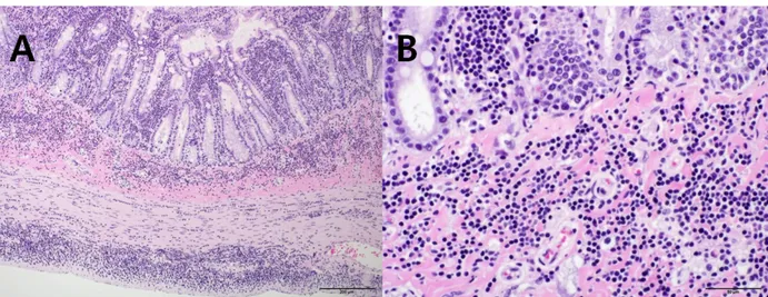 Fig. 2. Histopathological findings in the jejunum. (A) Neoplastic cells were observed in the mucosa, submucosa, muscularis, and serosa of the  jejunum