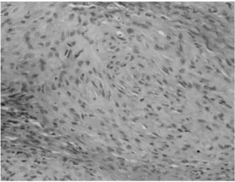 Fig. 1. Histopathological finding of A. Antoni B schwannoma pat- pat-terns characterized by pleomorphic, round, fusiform and polygonal  cells are seen