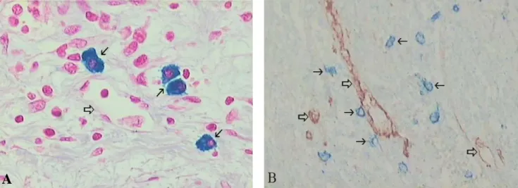 Fig 1. Mast cells stained with alcian blue(A) and immunostained with c-Kit(B) in invasive squamous cell carcinoma of the uterine  cervix