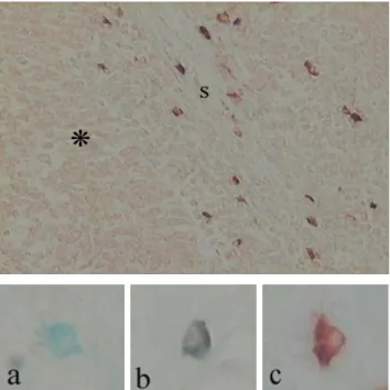 Fig. 8. VEGF-postive mast cells in tumor stroma(S). VEGF-  positive mast cells were confirmed by using a VEGF/alcian blue  double staining