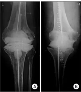 Fig. 2. Lateral views of left (A) and right (B) knee joints showing antibiotic  cement spacers.