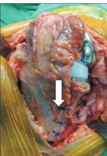 Fig. 5. Anteroposterior views of left (A) and right (B) knee joints, showing  constrained knee implants.