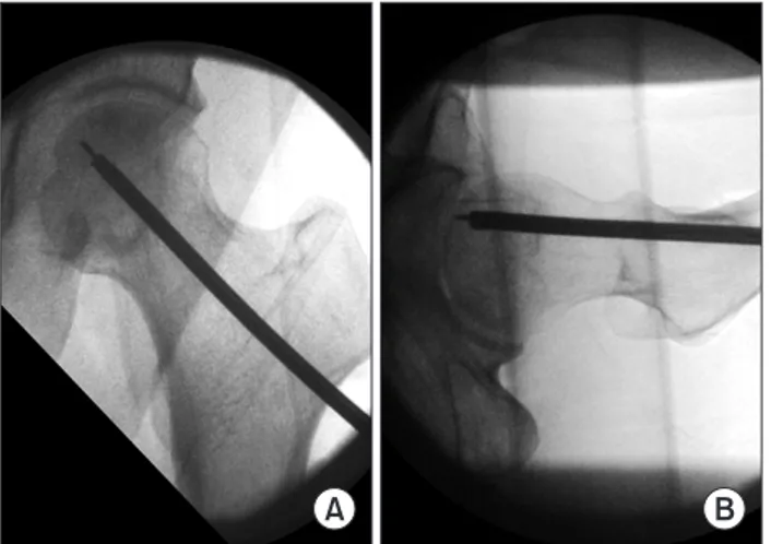 Fig. 1. Intraoperative anteroposterior (A) and lateral (B) fluoroscopic images  showing guide pin and reamer placement at the predetermined target.