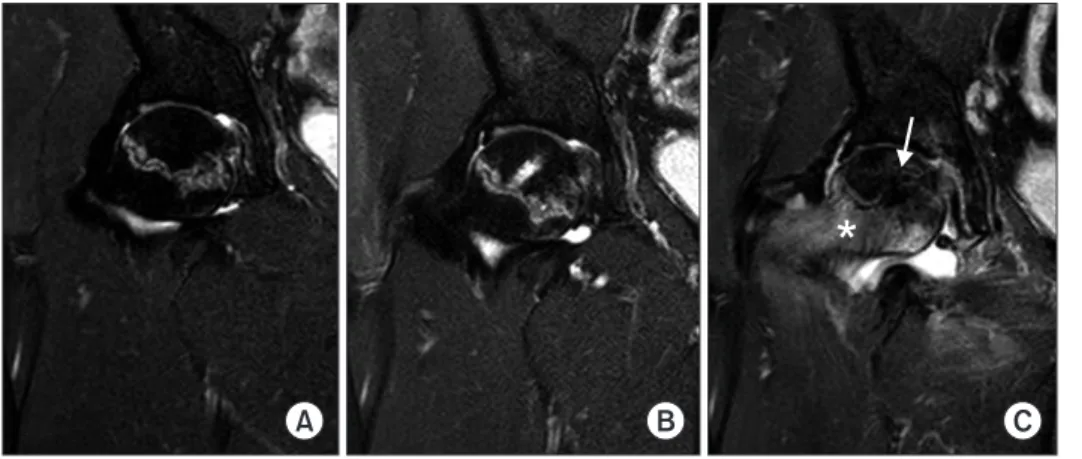 Fig. 5. Coronal T2 magnetic resonance  imaging (MRI) scans (case 5) showing  no definite widening of the high signal  intensity band inside the necrotic lesion  during follow-up