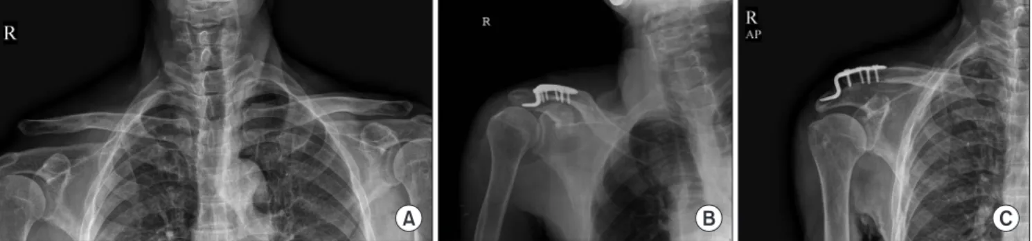 Fig. 1. (A) Right acromioclavicular joint showing a Rockwood type V acromioclavicular joint dislocation